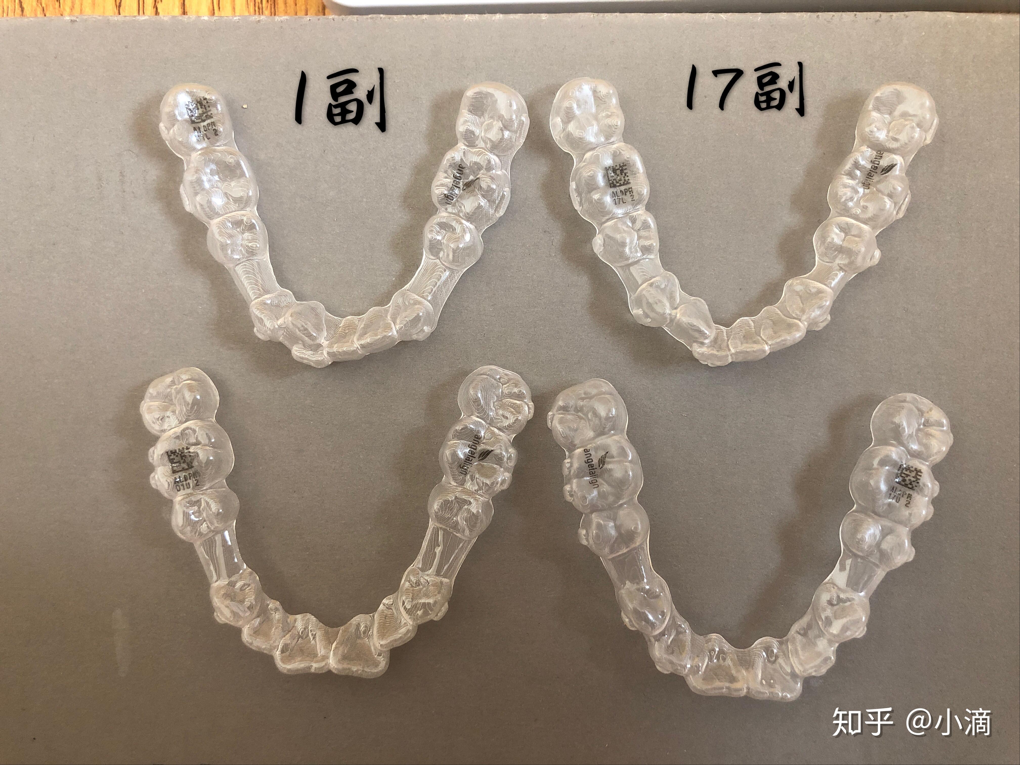 時(shí)代天使牙套價(jià)格揭秘，小巷中的美麗蛻變之旅啟動(dòng)！